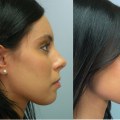 The Cost of a Nose Job: What You Need to Know