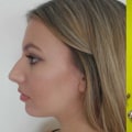 10 Ways to Afford a Nose Job - Expert Tips