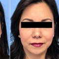 The True Cost of a Nose Job in Beverly Hills: What You Need to Know