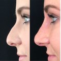 Paying for a Nose Job: What You Need to Know