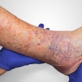 When Should I Seek Medical Attention for Skin Ulcer Symptoms