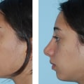 Who is suitable for closed rhinoplasty?