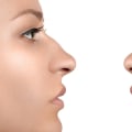 Affording a Nose Job on a Budget: Tips from a Plastic Surgeon