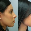 Where is the most affordable place to get a rhinoplasty?