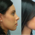 What is the cheapest state for rhinoplasty?