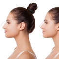 Who is a Good Candidate for Rhinoplasty?