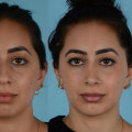 The Virtual Nose Surgery Revolution: How Technology is Changing the Rhinoplasty Game