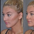 Who is the best closed rhinoplasty in beverly hills?