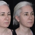 The Cost of a Deep Plane Facelift: What You Need to Know