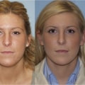 The Top Countries for Rhinoplasty: An Expert's Guide