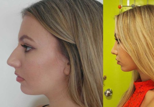 10 Ways to Afford a Nose Job - Expert Tips