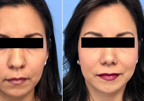 The True Cost of a Nose Job in Beverly Hills: What You Need to Know