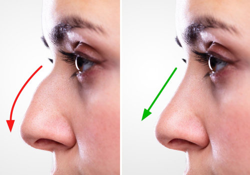 The Ultimate Guide to Choosing the Perfect Nose Job