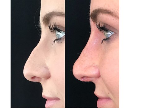 Paying for a Nose Job: What You Need to Know