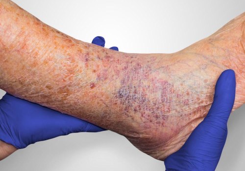 When Should I Seek Medical Attention for Skin Ulcer Symptoms
