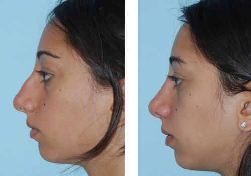 Who is suitable for closed rhinoplasty?