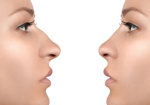 Affording a Nose Job on a Budget: Tips from a Plastic Surgeon