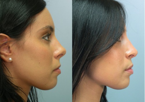 What is the cheapest state for rhinoplasty?