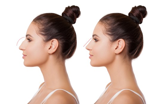 Who is a Good Candidate for Rhinoplasty?