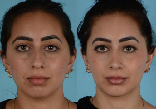 The Virtual Nose Surgery Revolution: How Technology is Changing the Rhinoplasty Game