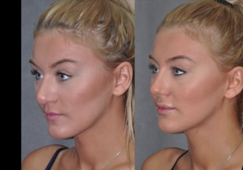 Who is the best closed rhinoplasty in beverly hills?