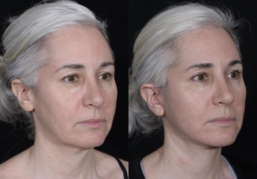 The Cost of a Deep Plane Facelift: What You Need to Know